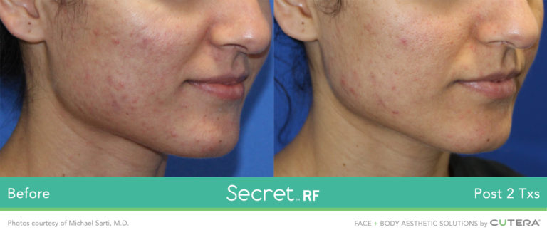 SECRET™ RF Microneedling Treatment in Green Bay, WI